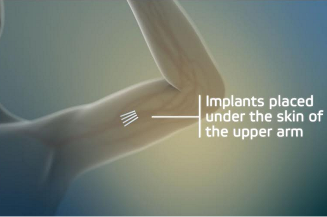 Computer-generated image of Probuphine implant in the upper arm