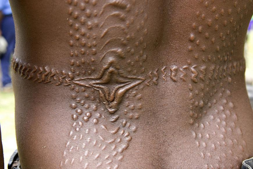 Alligator scale pattern scarring from scarification ritual