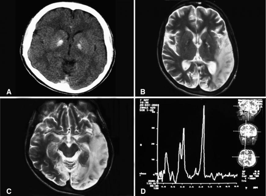 A computed tomography brain scan showing bilateral basal ganglia calfication