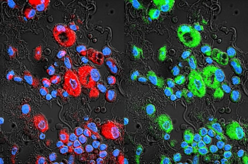 Drug-resistant lung cancer cells are in red. Paclitaxel-loaded exosomes (green) swarm the cancer cells and bypass their drug resistance.