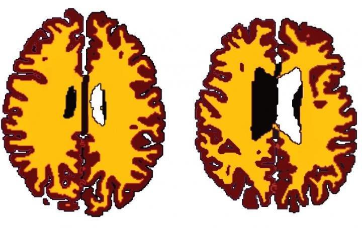 brain scans 