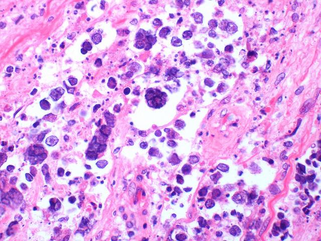 Small cell carcinoma infected with herpes simplex virus