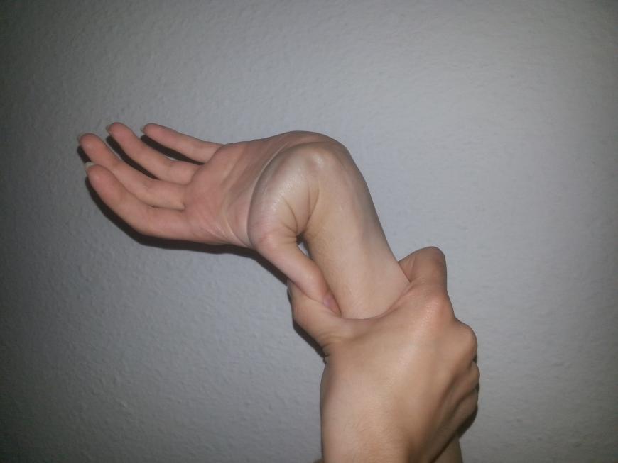 Hyperextension of the thumb so that it touches the back of the wrist.