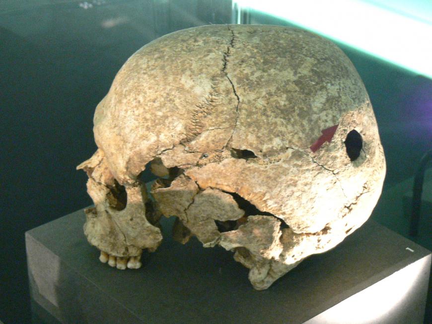 Human skull with trepanation.