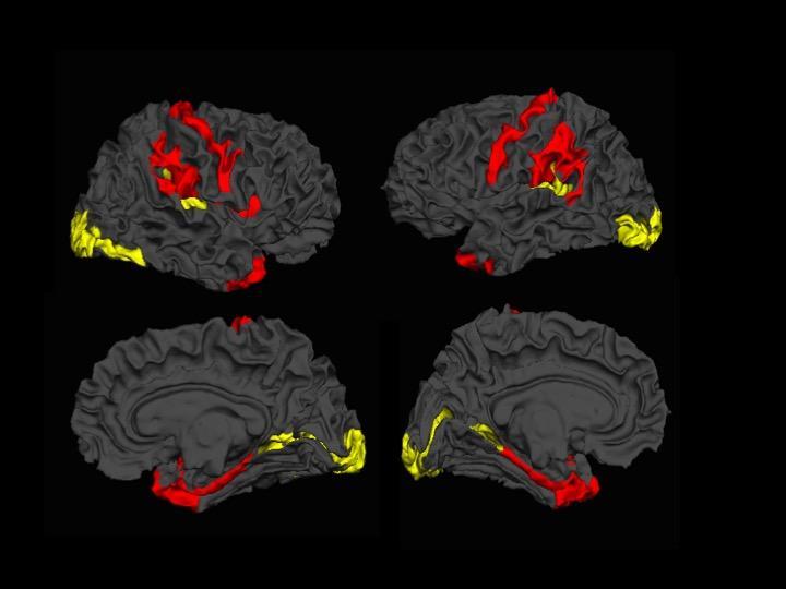 MRI imagery of schizophrenic brain. 