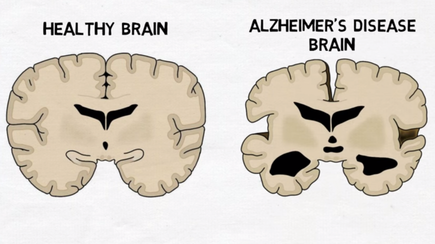 alzheimer&#039;s brain