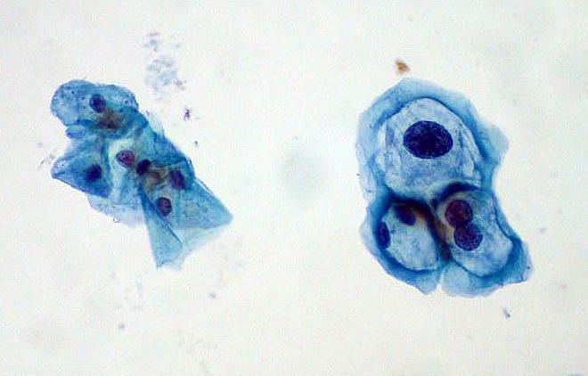 Pap smear comparing normal cervical cells (left) and HPV-infected cells (right)