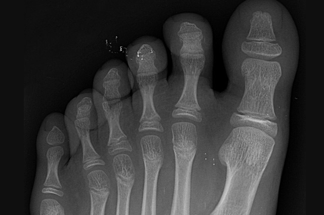 x-ray of polydactyly. Six toes on a foot