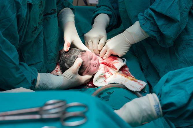 A baby is delivered via C-section