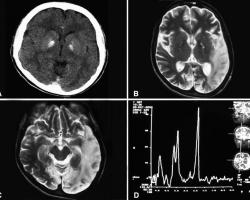 A computed tomography brain scan showing bilateral basal ganglia calfication