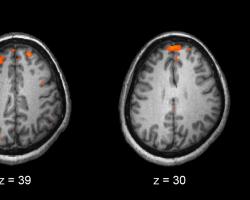 fMRI of the brain comparing healthy and schizophrenic individuals