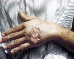 Photo of a large, open ulcer on the back of a patient&#039;s hand