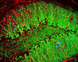 Protein plaques in the brain that that cause Alzheimer&#039;s disease