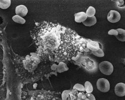 A white blood cell known as a macrophage attacks a tumor cell in immunotherapy