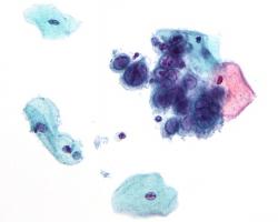 Micrograph showing the changes of herpes simplex virus