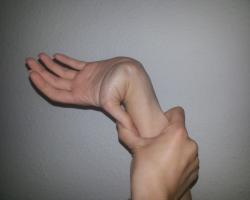 Hyperextension of the thumb so that it touches the back of the wrist.