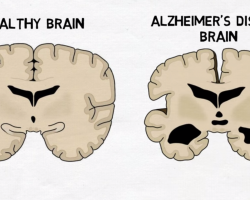 alzheimer&#039;s brain
