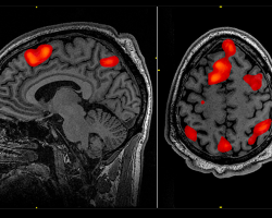 Black and white brain scan with small regions of the brain highlighted in red